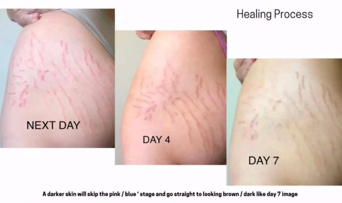 Scar and Stretch Mark Camouflage Healing Process North Brisbane