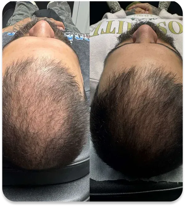 Scar and Stretch Mark Camouflage North Brisbane