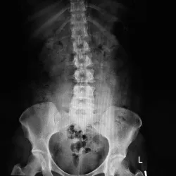 Lumbar x-ray Image