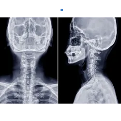 Cervical x-ray Image