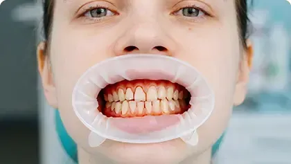 Bleeding Gum Treatment West Chester OH