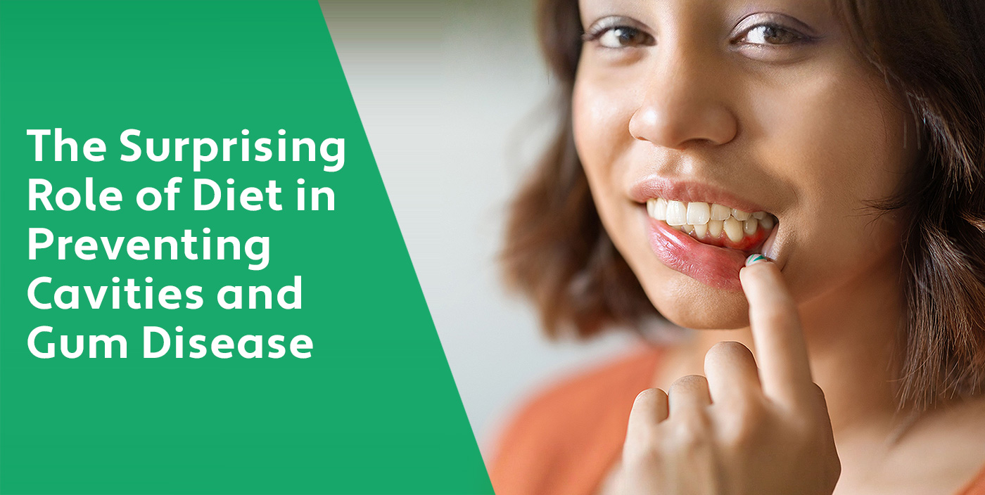 The Surprising Role of Diet in Preventing Cavities and Gum Disease | West Chester OH