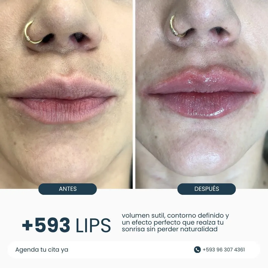 Resultado de paciente - Rinoplastia