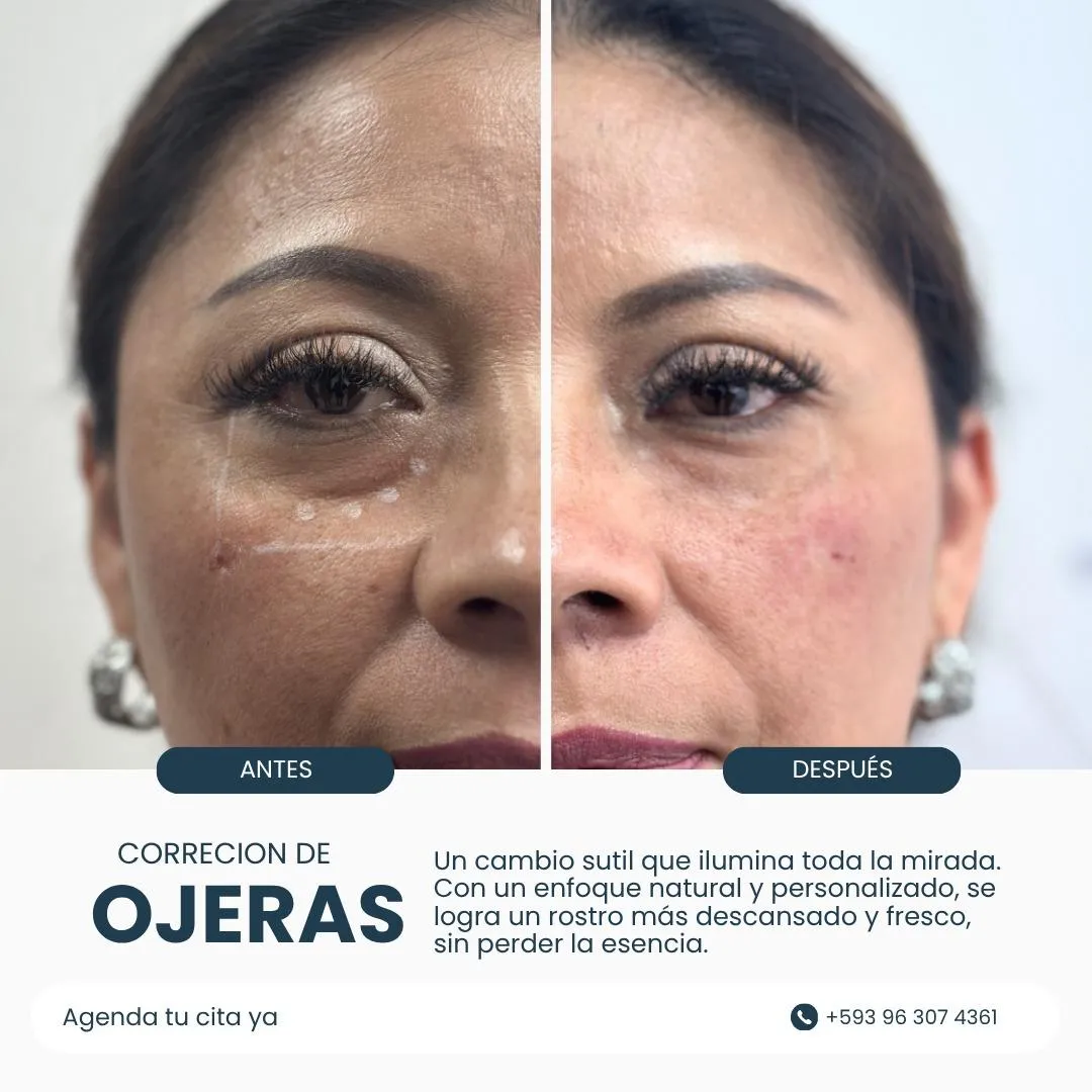 Resultado de paciente - Lipoescultura