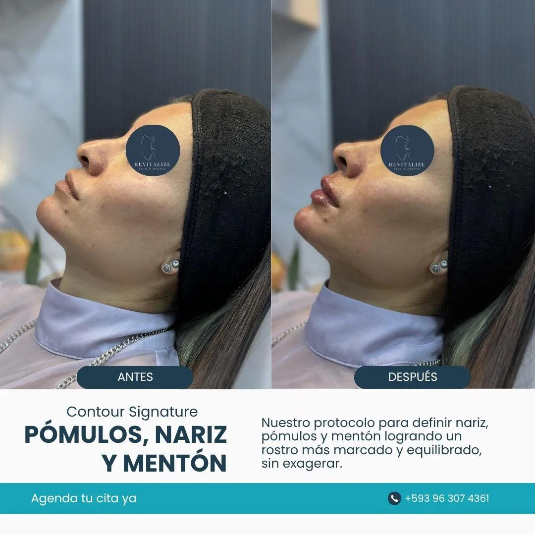 Resultado de paciente - Abdominoplastia