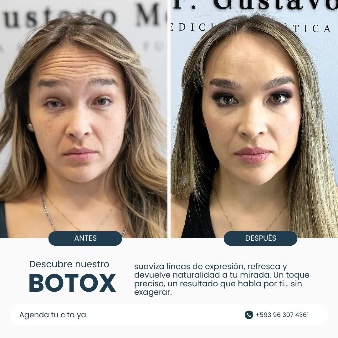 Resultado de paciente - Blefaroplastia
