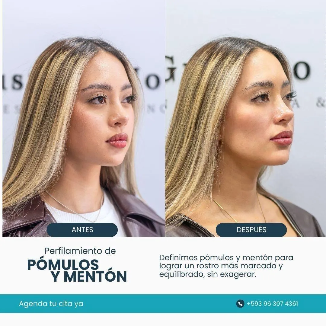 Resultado de paciente - Lifting Facial