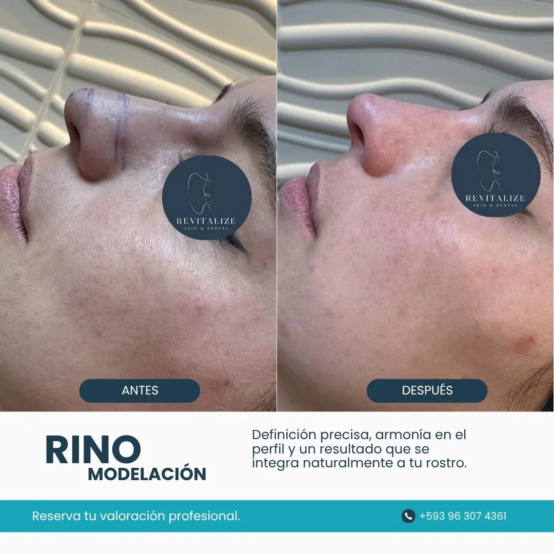 Resultado de paciente - Mamoplastia