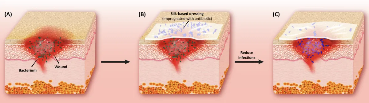 Illustration of wound healing stages with silk-based dressing at Royal Wound Care, highlighting antibiotic application and infection reduction in advanced wound care.