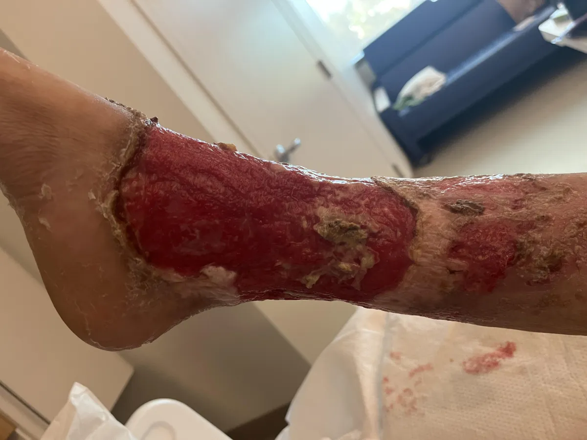 Chronic leg wound treated with biologic dressing at Royal Wound Care, using advanced wound treatments for diabetic ulcers and non-healing wounds.