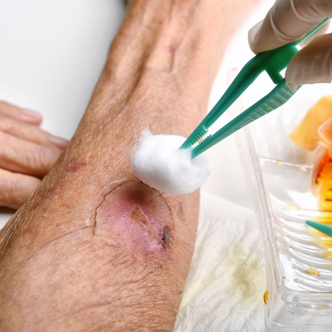 Wound Care for Elderly Thin Skin: Best Practices and Treatments