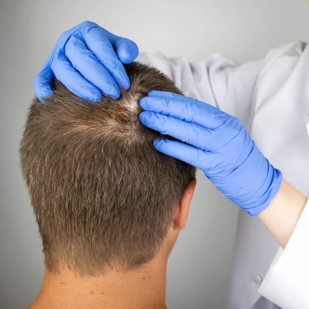 How to Treat a Scalp Wound