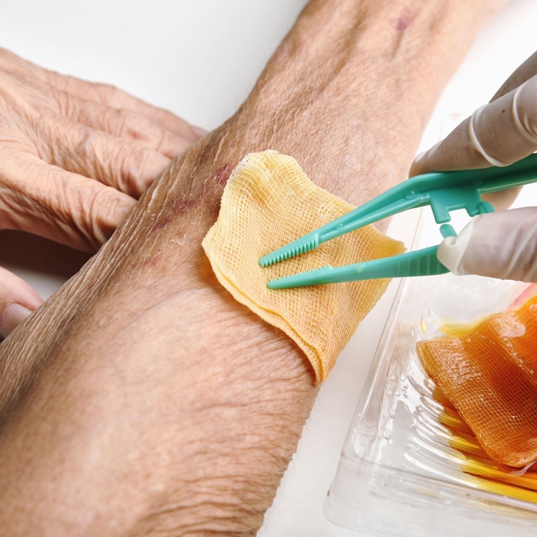 How Long Can Xeroform Gauze Stay On A Wound