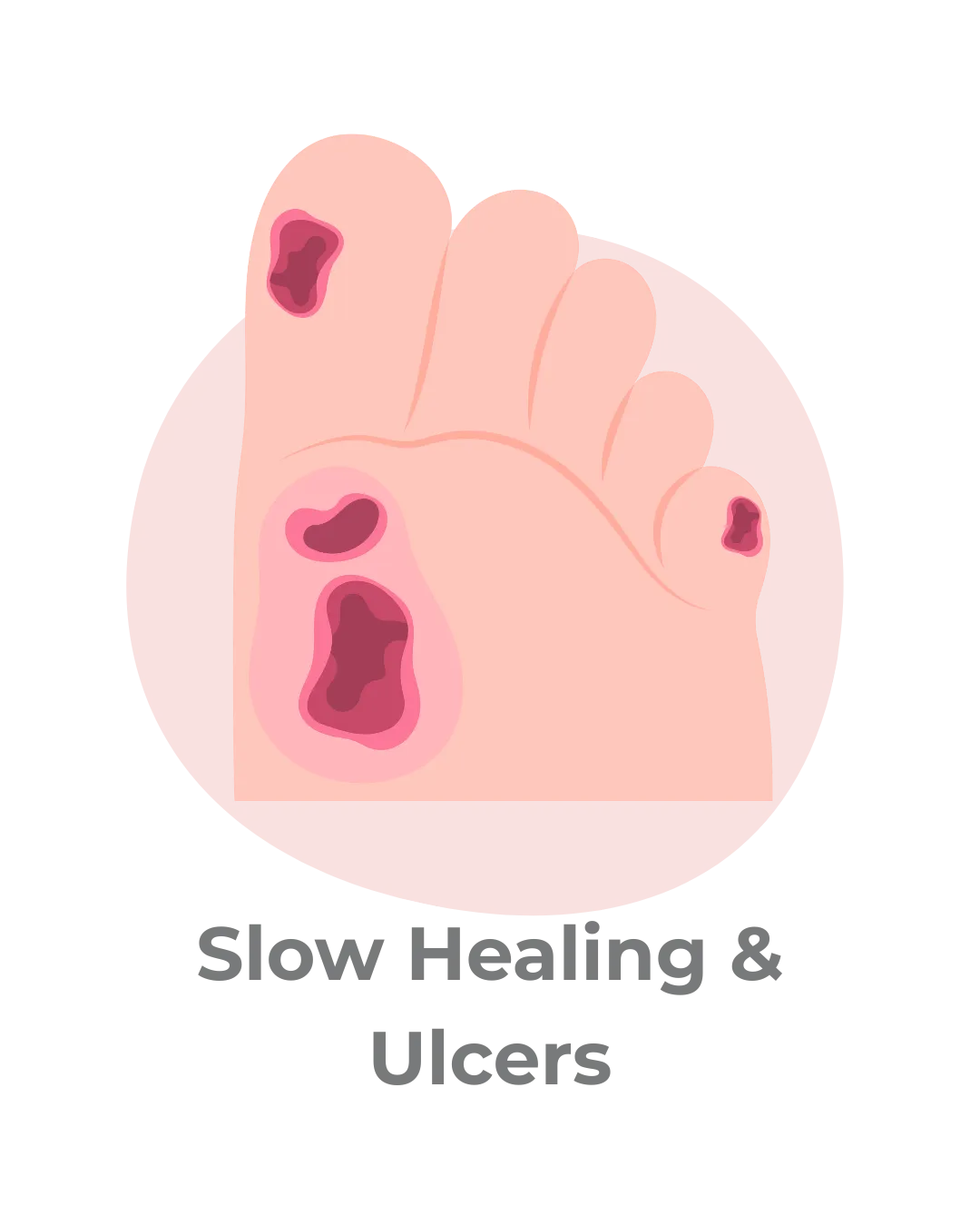 foot ulcers and slow healing associated with neuropathy