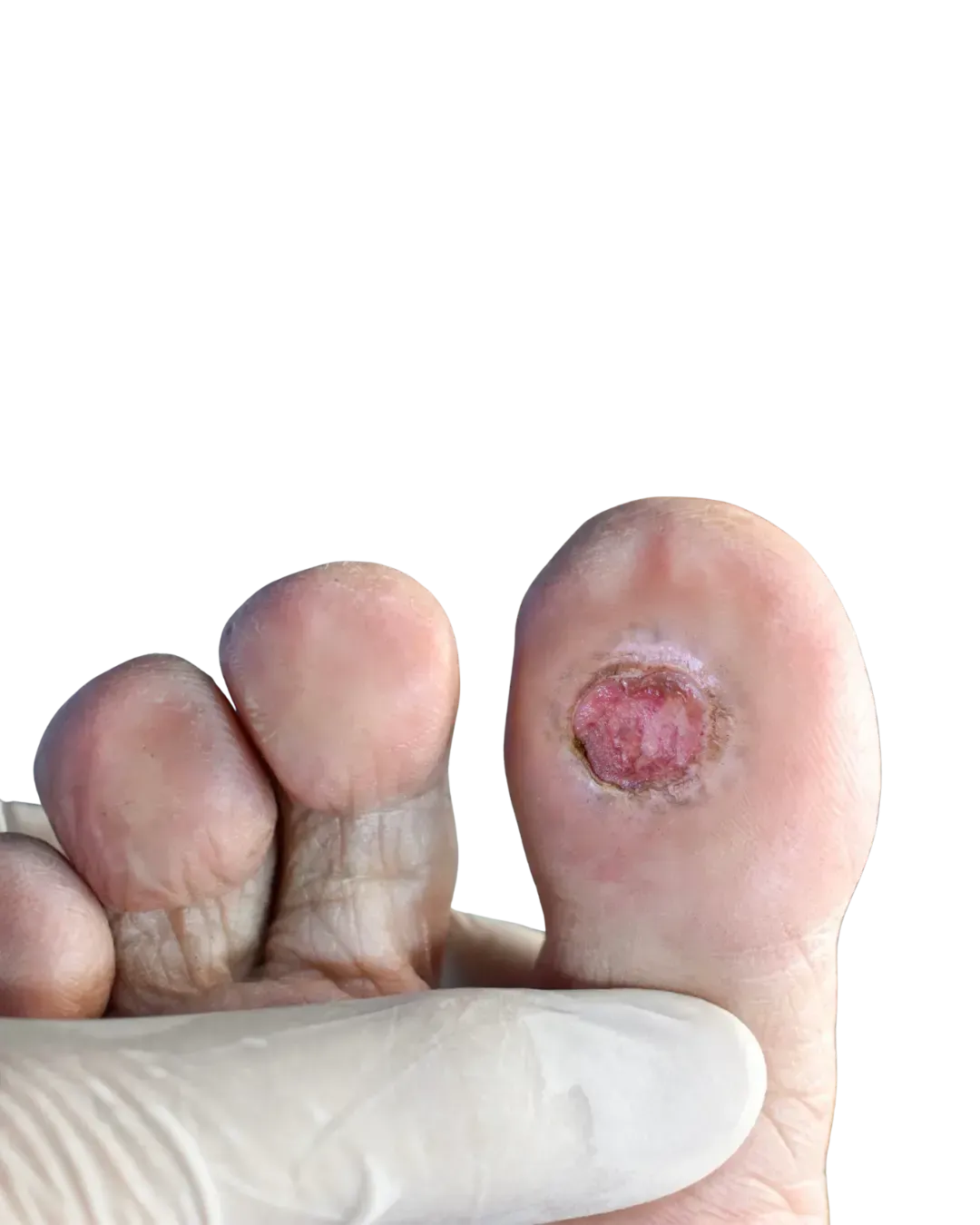 non-healing foot ulcer associated with peripheral neuropathy