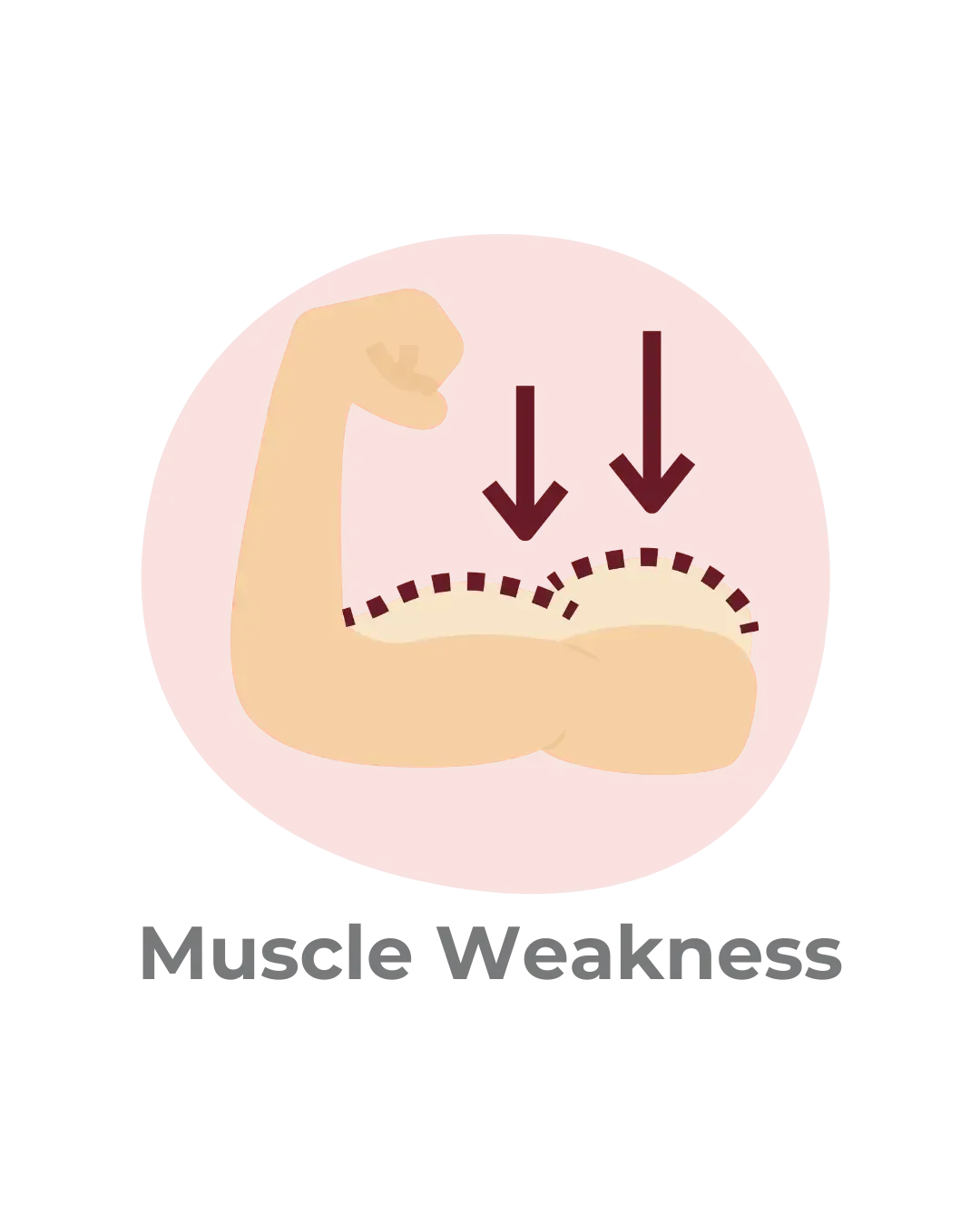 arm showing muscle weakness caused by neuropathy