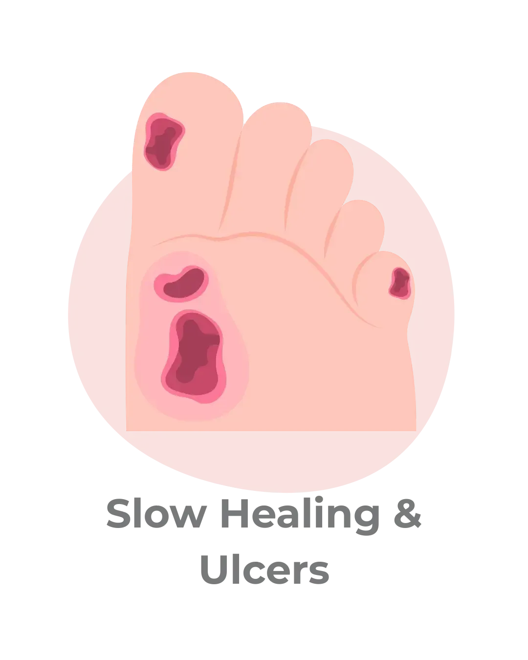 foot ulcers and slow healing associated with neuropathy