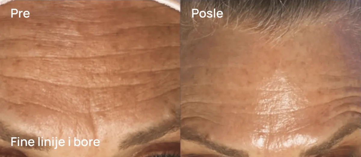 MedSpa rezultat - pre i posle