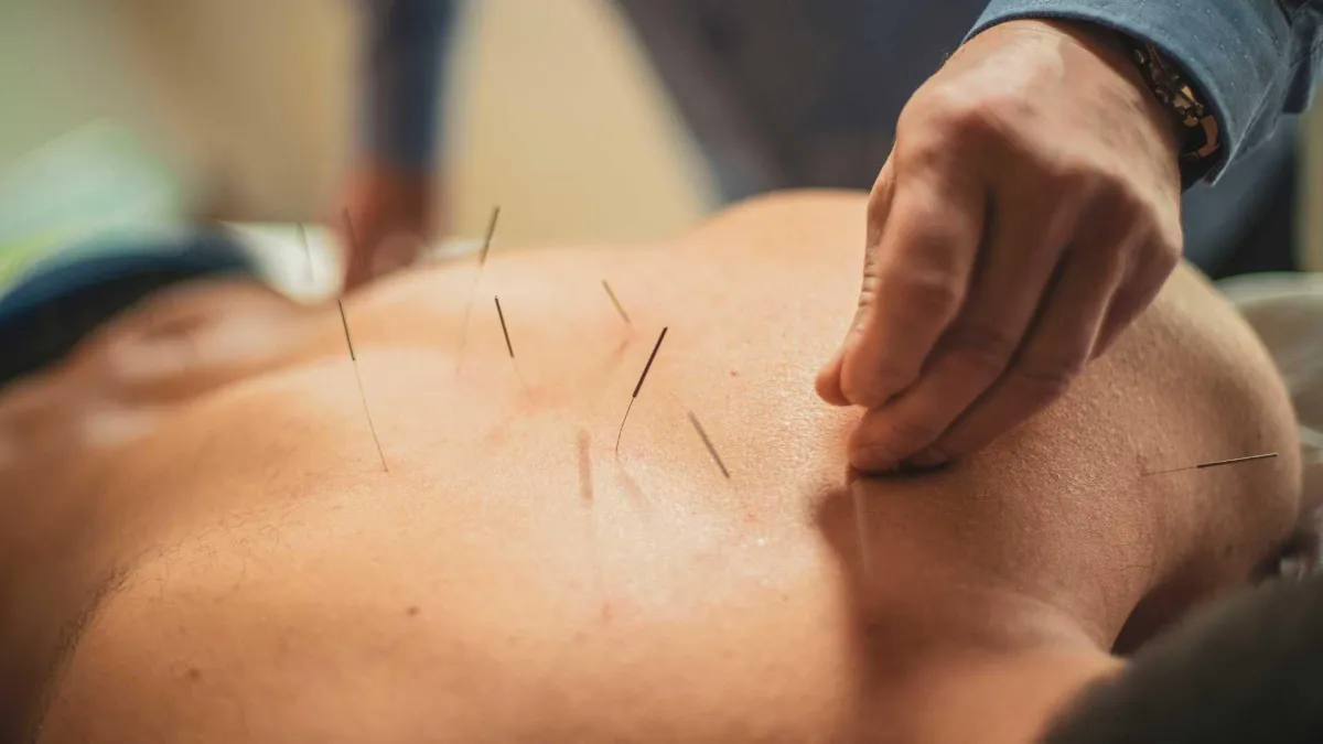 Acupuncture Therapy