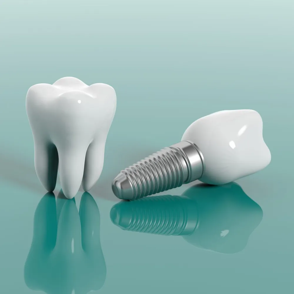 Dental Implants