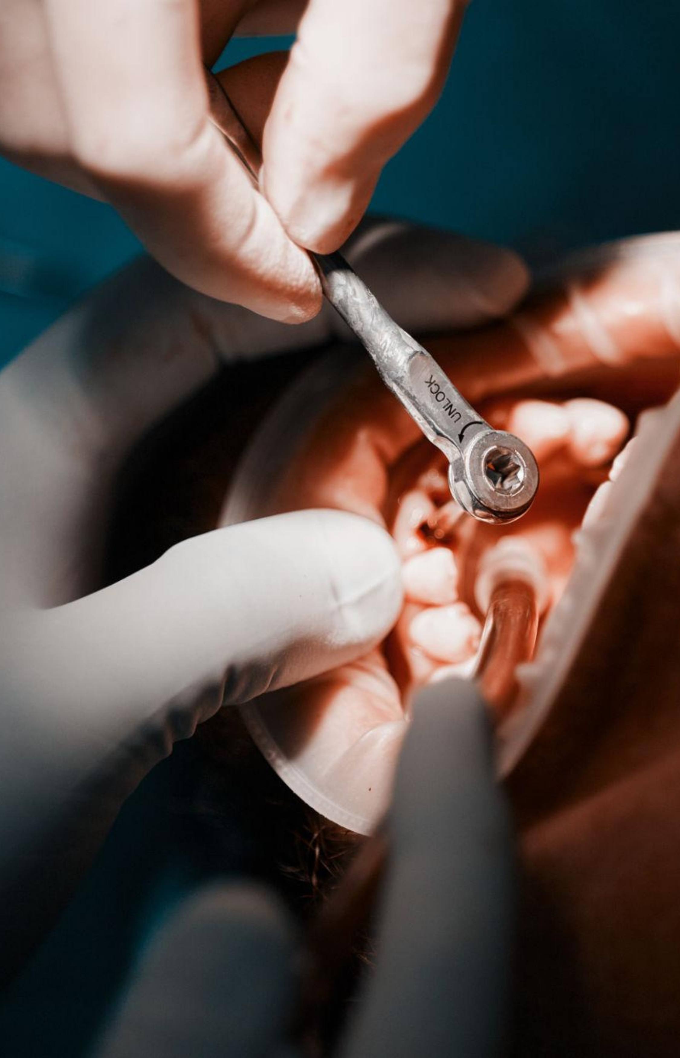 Dental Implants in Trivandrum