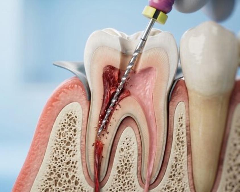 Root Canal Treatment in Maruthumkuzhi, Trivandrum