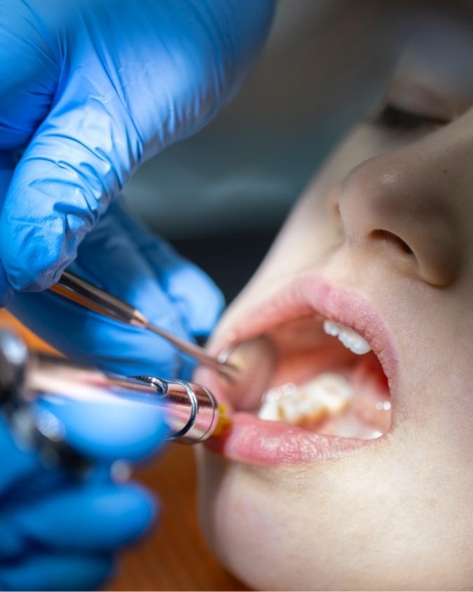 Root Canal Dentist in Trivandrum