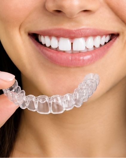 Invisible Braces in Trivandrum
