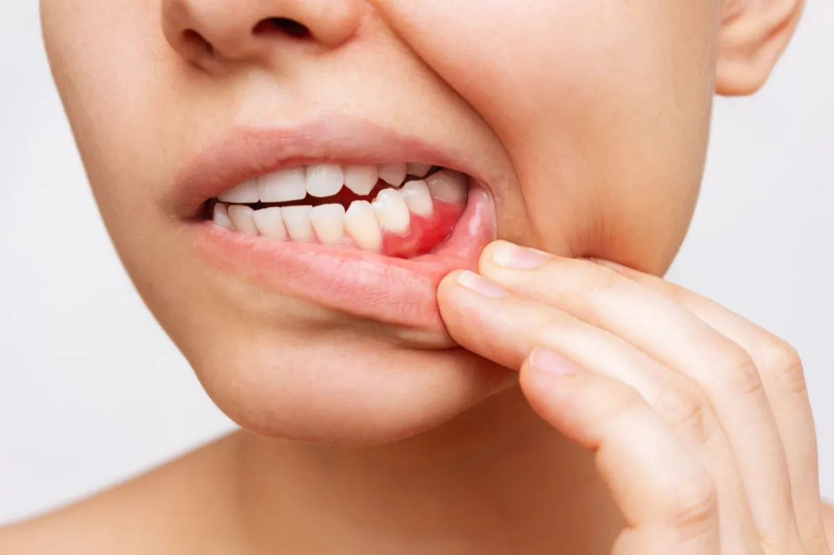 Gum Treatment in Maruthankuzhi, Thiruvananthapuram