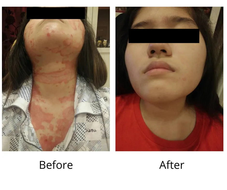 eczema treatment, eczema solution, 