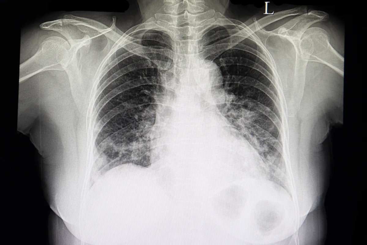 Congestive Heart Failure