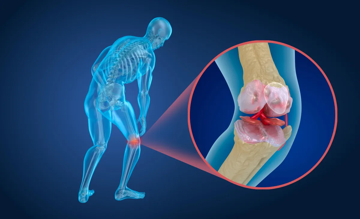 Osteoarthritis/Inflammatory Arthritis