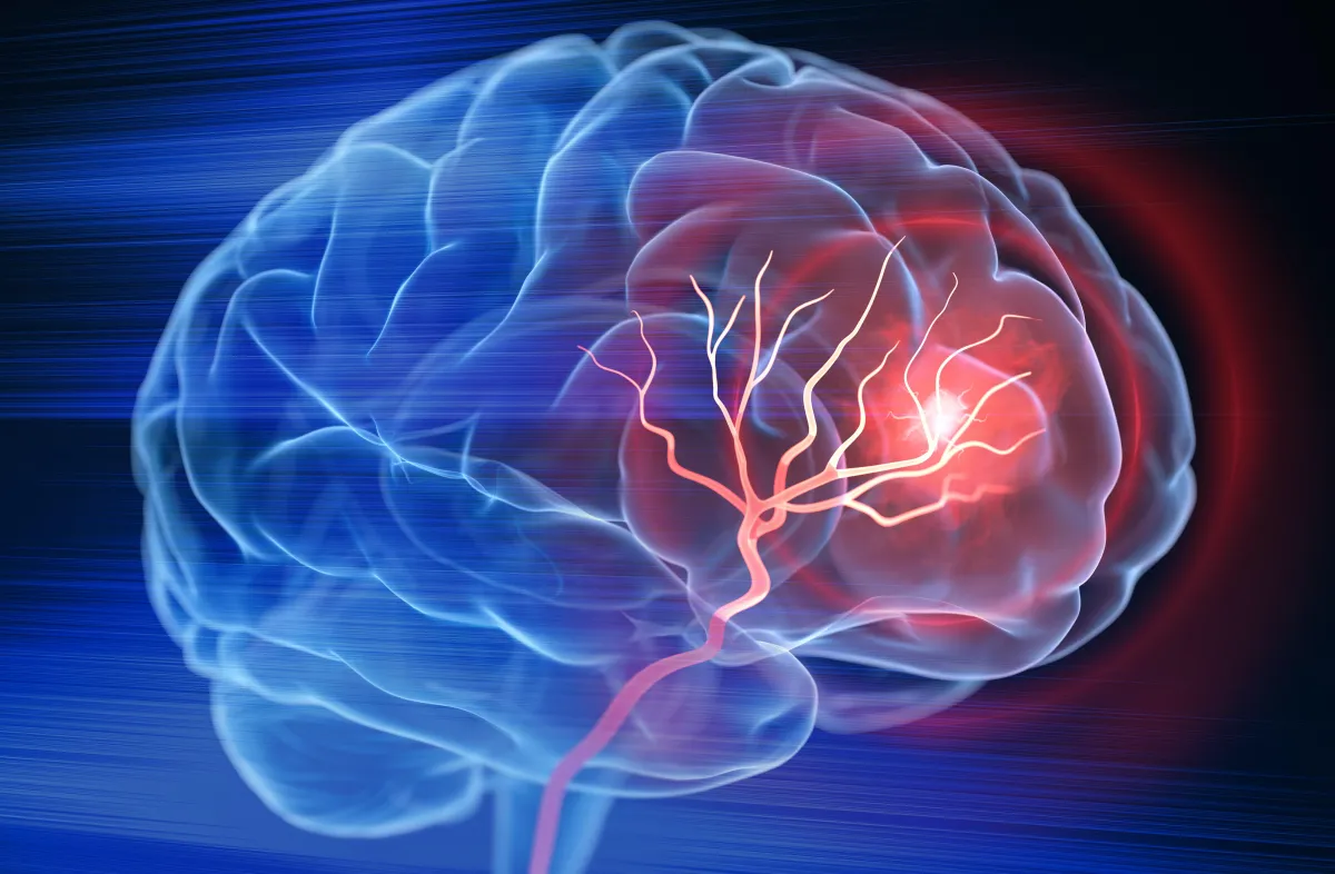 Stroke/Stroke Prevention