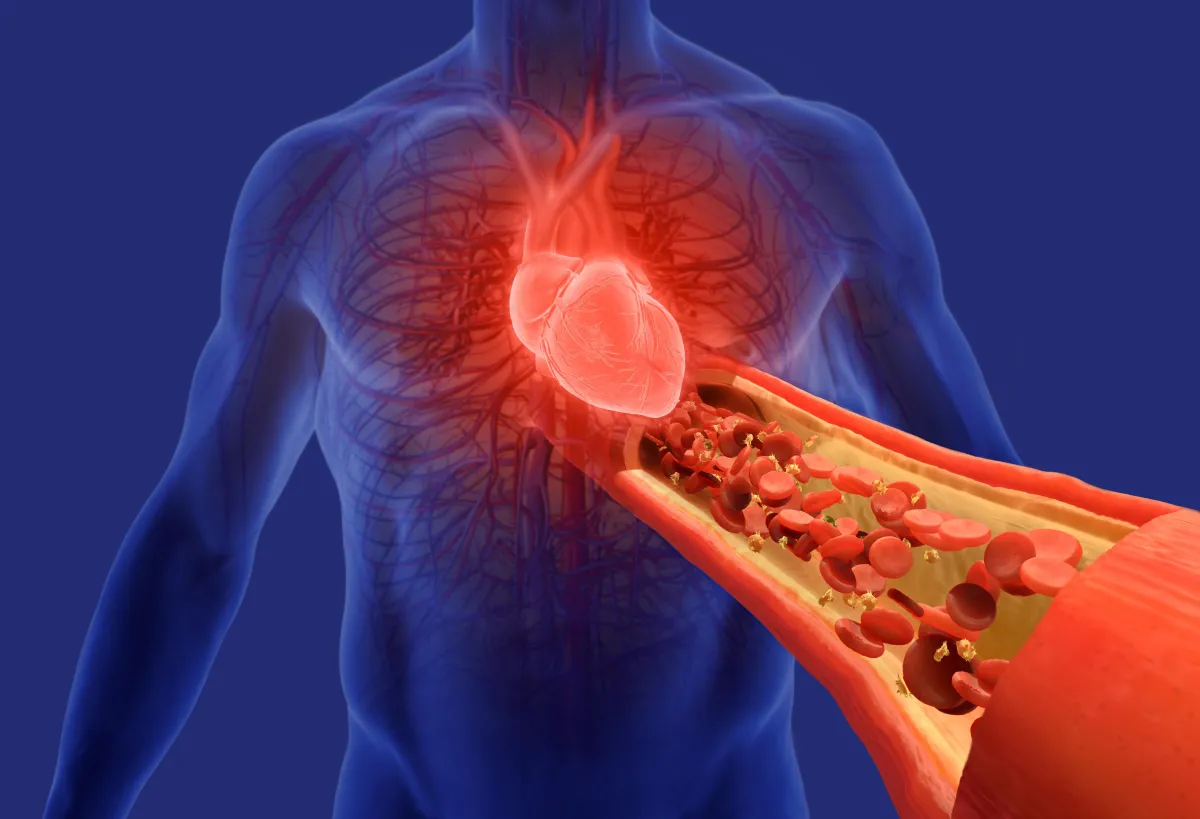 Hypertension
