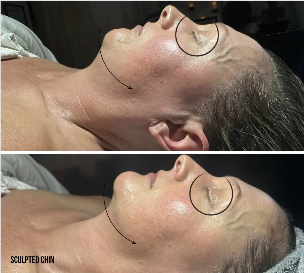 Before and after photo - Client received a anti-aging, dexoting, c02 carboxy facial treatment from Korean Skincare by Lindsay Rose Ali at Lindsay Rose Beauty in Mansfield, Texas
