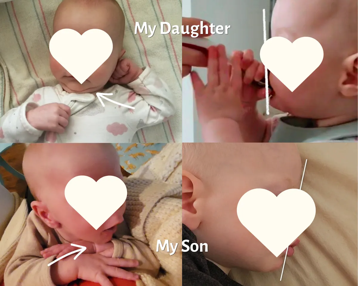 before and after of baby recessed jaw