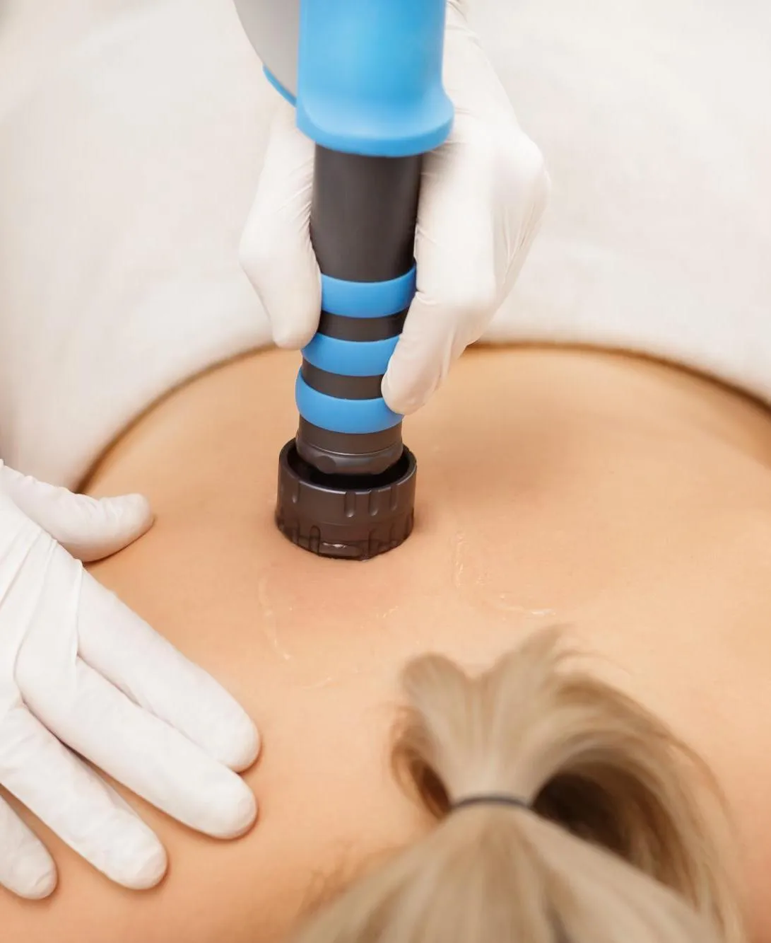 Dry Needling