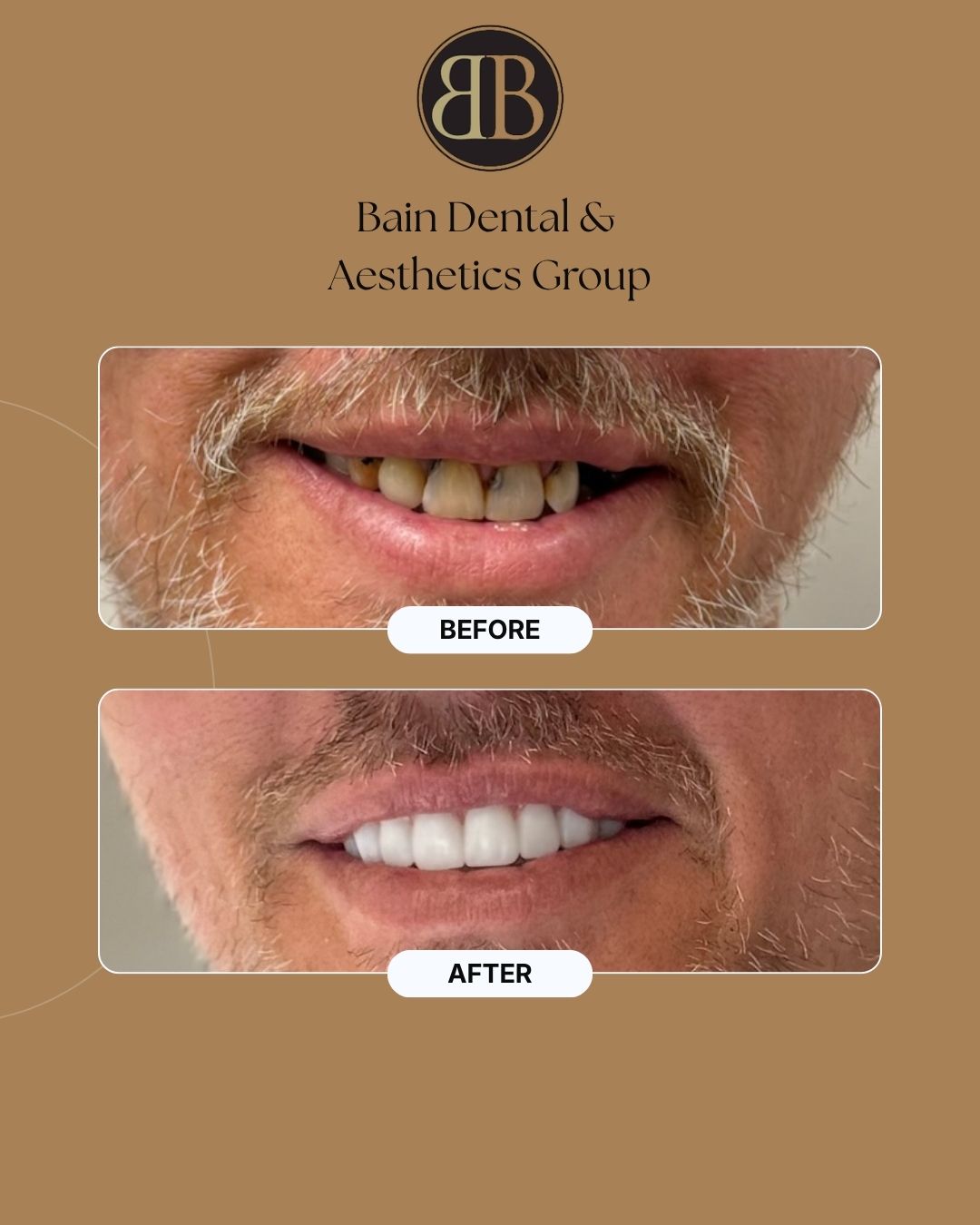 Dentures, Bain Dental & Aesthetics Group, Bowdon GA