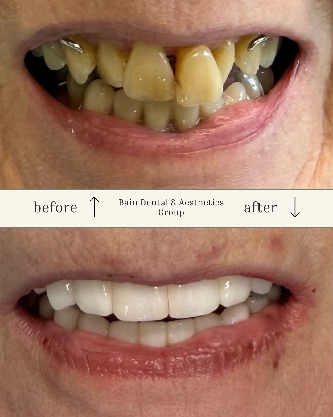 Hybrid Dentures, Bain Dental & Aesthetics Group, Bowdon GA