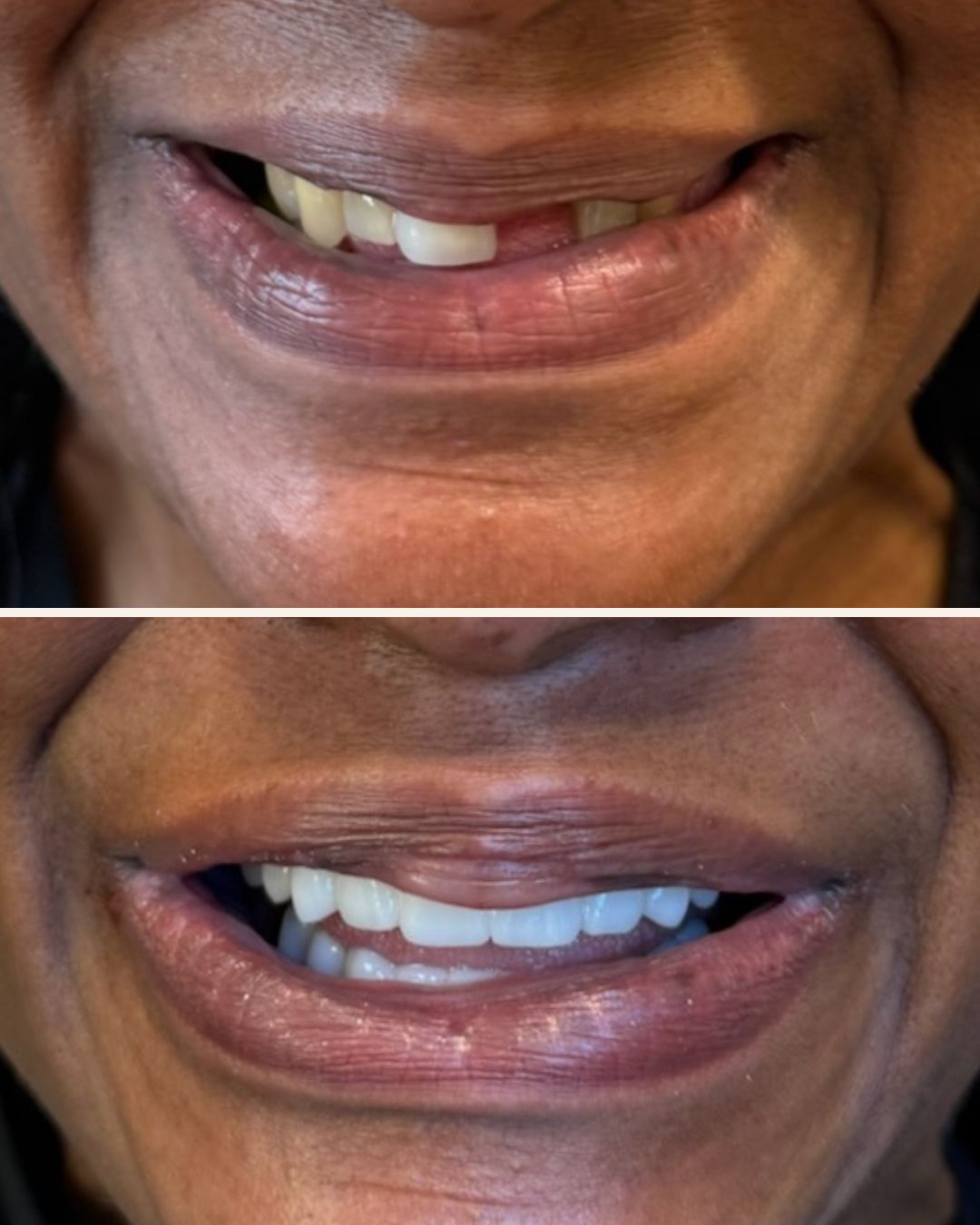 Zirconia Full Arch, Bain Dental & Aesthetics Group, Bowdon GA