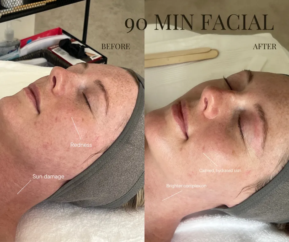 anti aging facial before and after ashburn va
