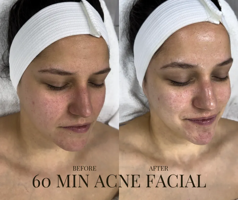 acne facial before and after ashburn va