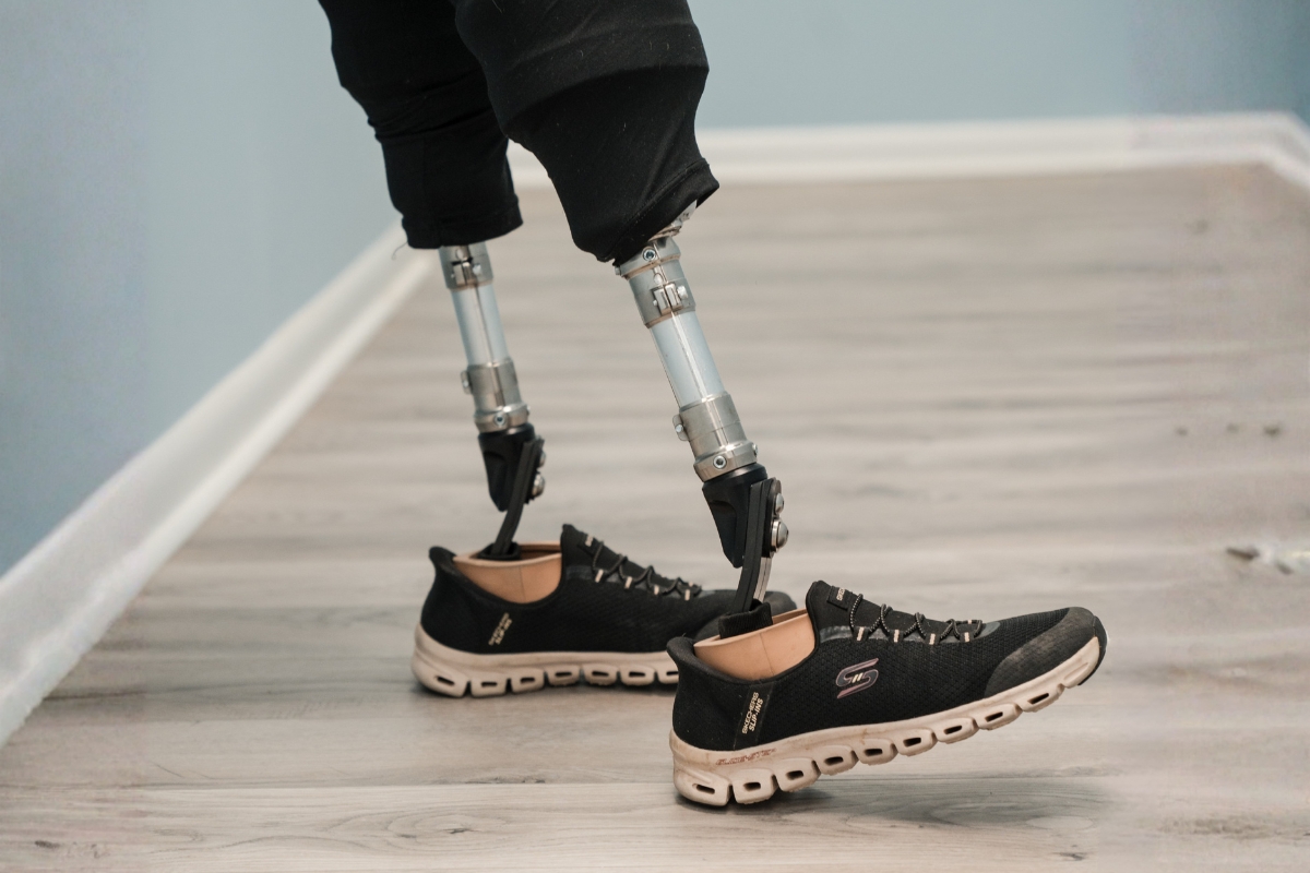 Bilateral prosthetic legs during a follow-up visit to check comfort, fit, and mobility