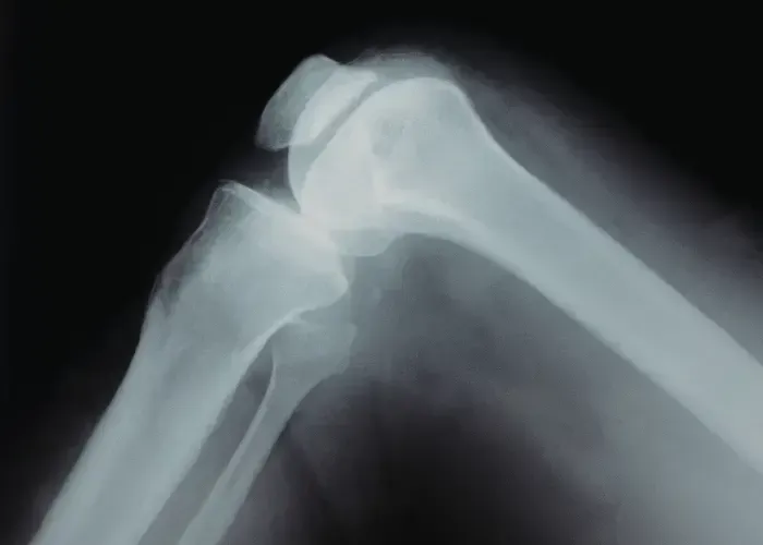 Patellofemoral Tracking Syndrome Fort Mill