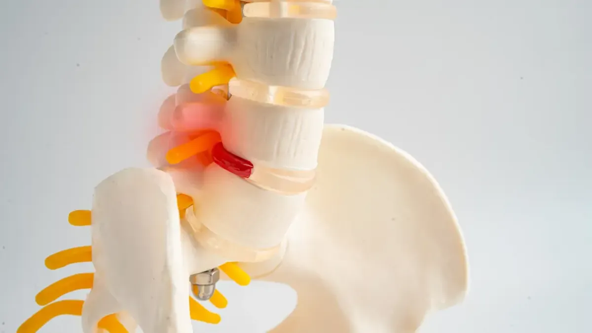 An anatomical spine model demonstrating a prominent red herniated disc compressing a yellow nerve root, used to explain sciatica treatment options in Fort Mill, SC.