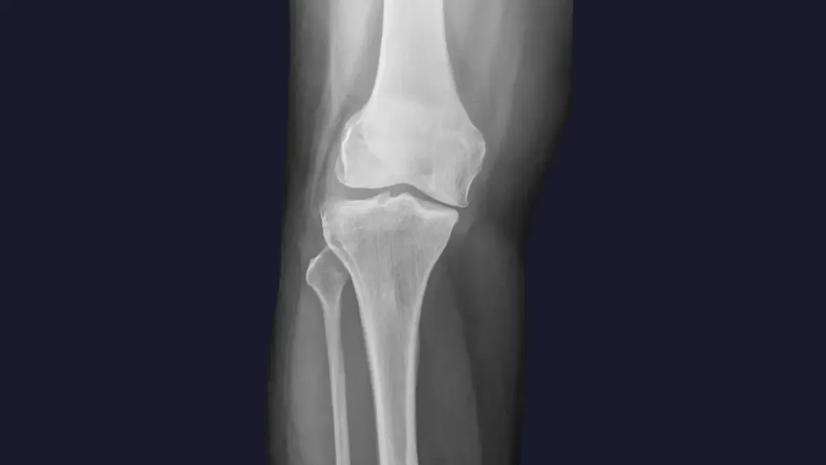 A medical X-ray scan of a human knee joint showing the femur, patella, and tibia bones, utilized for diagnostic analysis of knee pain in Fort Mill, SC.