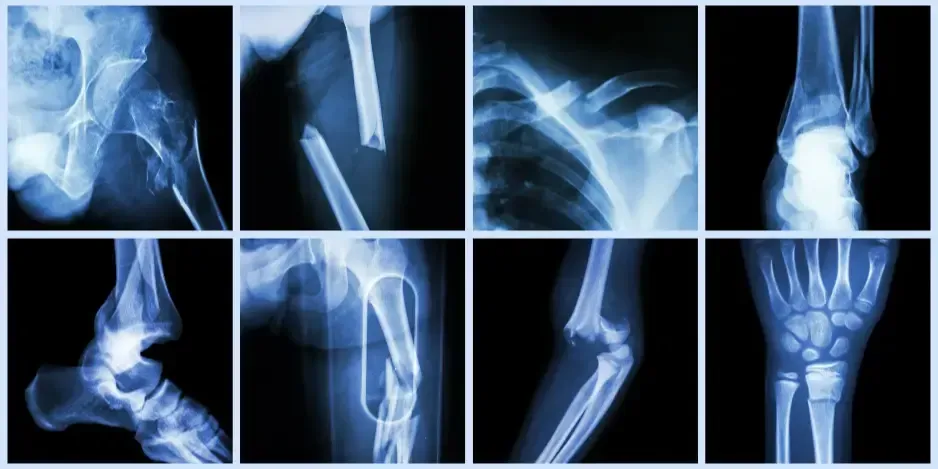 Medical X-rays showing bone fractures and structural damage linked to osteoporosis risk evaluated by a chiropractor in Fort Mill SC