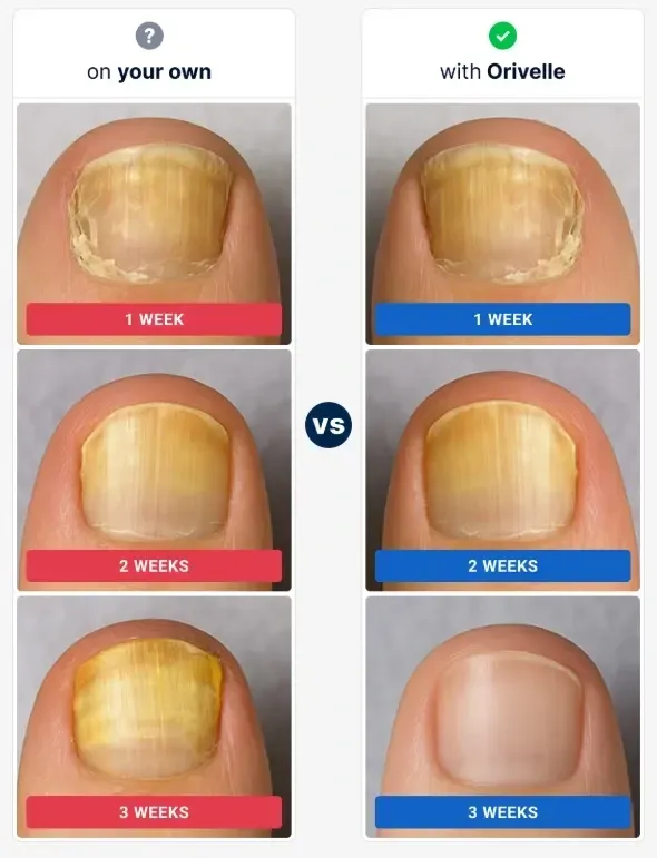 Nail Fungus vs Orivelle