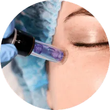 Tratamiento Facial cn Dermapen/Microneedling Minerva Estetic