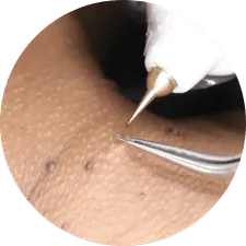 Fibroplast Minerva Estetic
